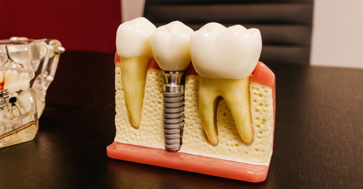 Ceramic dental implants with bolt in artificial mouth piece on desktop in hospital